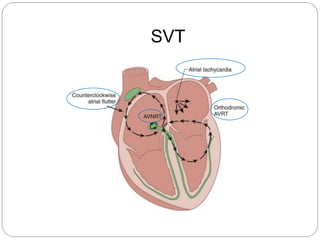 SVT
 