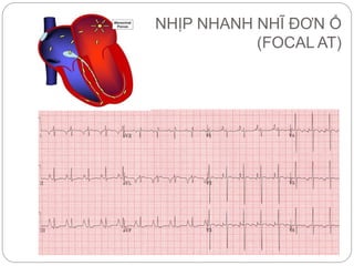 NHỊP NHANH NHĨ ĐƠN Ổ
(FOCAL AT)
 
