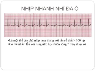 NHỊP NHANH NHĨ ĐA Ổ
•Là một thể của chủ nhịp lang thang với tần số thất > 100 l/p
•Có thể nhầm lẫn với rung nhĩ, tuy nhiên sóng P thấy được rõ
 