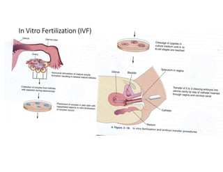 In Vitro Fertilization (IVF)
 
