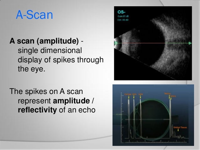 B scan