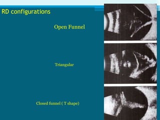 Closed Funner Rdb Scan B scan | PPTX