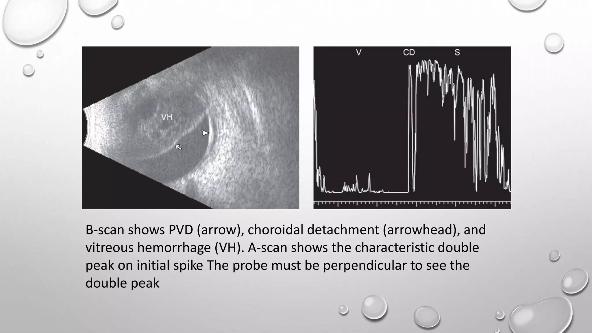 Ultrasound of eye - B scan | PPTX