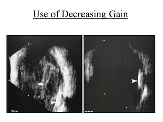 Use of Decreasing Gain 
 