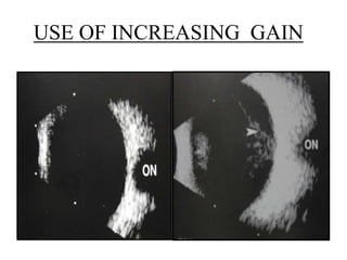USE OF INCREASING GAIN 
 
