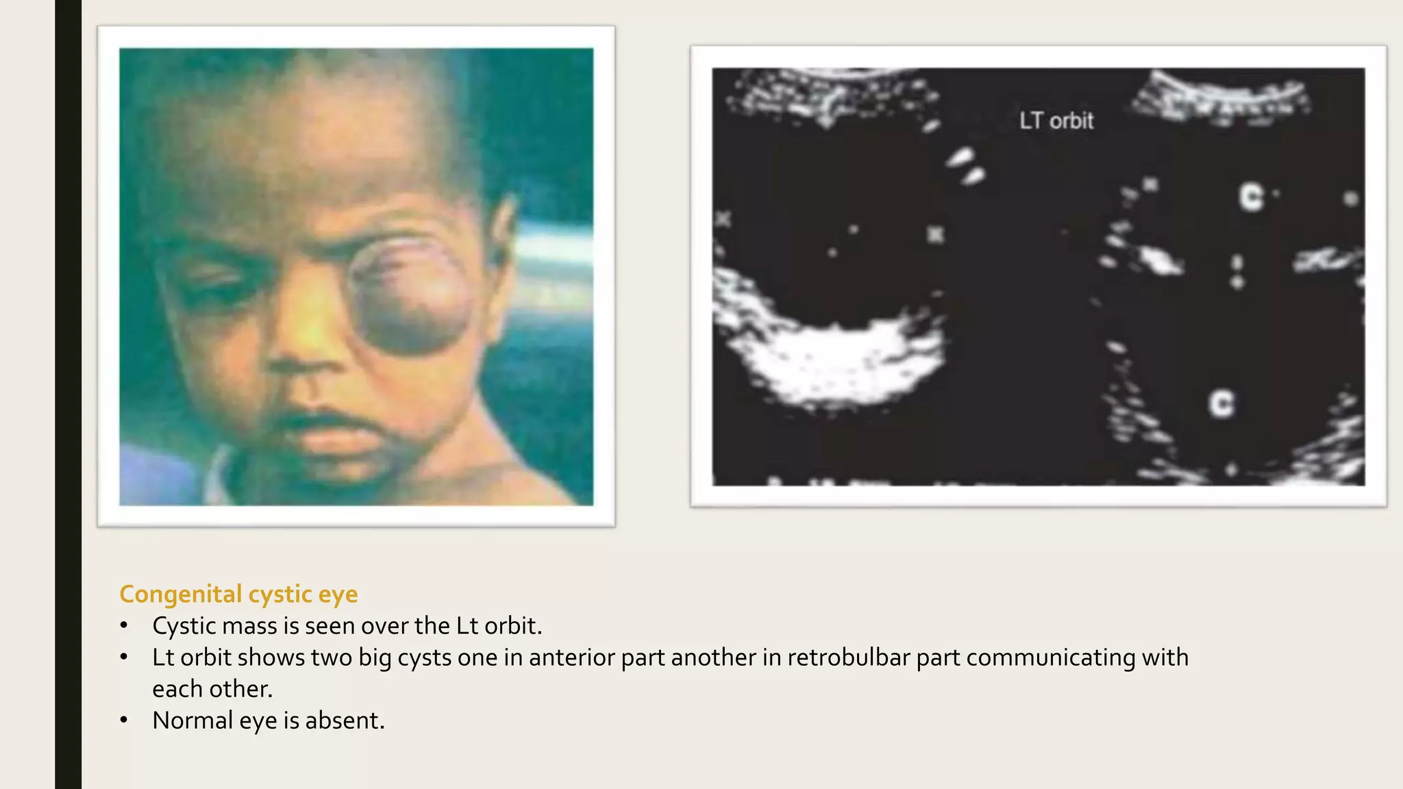 B scan clinical cases 1 | PPTX