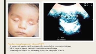 Pphpv Eye B scan clinical cases 1 | PPTX