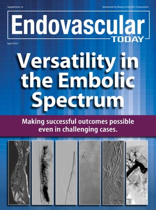 Supplement to Sponsored by Boston Scientific Corporation
April 2013
Versatility in
the Embolic
Spectrum
Making successful outcomes possible
even in challenging cases.
 