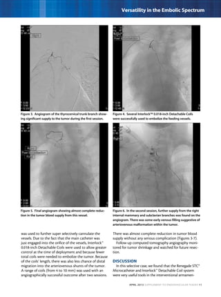 April 2013 Supplement to Endovascular Today 11
Versatility in the Embolic Spectrum
was used to further super selectively cannulate the
vessels. Due to the fact that the main catheter was
just engaged into the orifice of the vessels, Interlock™
0.018-inch Detachable Coils were used to allow greater
control at the time of deployment and because fewer
total coils were needed to embolize the tumor. Because
of the coils’ length, there was also less chance of distal
migration into the arteriovenous shunts of the tumor.
A range of coils (from 4 to 10 mm) was used with an
angiographically successful outcome after two sessions.
There was almost complete reduction in tumor blood
supply without any serious complication (Figures 3-7).
Follow-up computed tomography angiography moni-
tored for tumor shrinkage and watched for future resec-
tion.
DISCUSSION
In this selective case, we found that the Renegade STC®
Microcatheter and Interlock™ Detachable Coil system
were very useful tools in the interventional armamen-
Figure 3. Angiogram of the thyrocervical trunk branch show-
ing significant supply to the tumor during the first session.
Figure 5. Final angiogram showing almost complete reduc-
tion in the tumor blood supply from this vessel.
Figure 4. Several Interlock™ 0.018-inch Detachable Coils
were successfully used to embolize the feeding vessels.
Figure 6. In the second session, further supply from the right
internal mammary and subclavian branches was found on the
angiogram. There was some early venous filling suggestive of
arteriovenous malformation within the tumor.
 