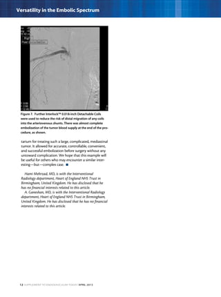 12 Supplement to Endovascular Today April 2013
Versatility in the Embolic Spectrum
tarium for treating such a large, complicated, mediastinal
tumor. It allowed for accurate, controllable, convenient,
and successful embolization before surgery without any
untoward complication. We hope that this example will
be useful for others who may encounter a similar inter-
esting—but—complex case.  n
Hami Mehrzad, MD, is with the Interventional
Radiology department, Heart of England NHS Trust in
Birmingham, United Kingdom. He has disclosed that he
has no financial interests related to this article.
A. Ganeshan, MD, is with the Interventional Radiology
department, Heart of England NHS Trust in Birmingham,
United Kingdom. He has disclosed that he has no financial
interests related to this article.
Figure 7. Further Interlock™ 0.018-inch Detachable Coils
were used to reduce the risk of distal migration of any coils
into the arteriovenous shunts. There was almost complete
embolization of the tumor blood supply at the end of the pro-
cedure, as shown.
 