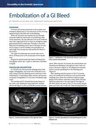 14 Supplement to Endovascular Today April 2013
Versatility in the Embolic Spectrum
By Trevor Cleveland, MD, Sheffield Vascular Institute
Embolization of a GI Bleed
OVERVIEW
A 94-year-old woman presented to the accident and
emergency department in the early hours of the morning
(approximately 2:00 AM) with rectal bleeding.
When she arrived to the hospital, she was hemody-
namically stable but had further rectal bleeding. After
initial assessment, she was referred to the acute medicine
team who organized for her to have an emergency upper
gastrointestinal (GI) endoscopy. Clinically, it was most
likely that the bleeding source was in the lower GI tract,
but an upper GI source needed to be excluded at an
early stage. Proctoscopy was obscured by the blood in
the rectum.
The upper GI endoscopy was normal, with no evi-
dence of blood as far as the second part of her duode-
num.
Despite the administered clear fluids and blood, her
hemoglobin, which was 11 g/dL on admission, had fallen
to 8 g/dL.
PROCEDURE DESCRIPTION
At 7:30 AM, the interventional radiology team (radi-
ologist, radiographer, and nurse) was contacted to con-
sider trying to find the bleeding source and treat it with
embolization. A triple-phase (plain, arterial, and venous)
computed tomography (CT) scan was immediately orga-
nized.
The unenhanced CT showed diverticular disease of
the colon, with calcification associated with multiple
diverticula (Figure 1); this can look like contrast extrava-
sation. After injection of contrast, the arterial phase scan
showed active bleeding in the sigmoid colon, with con-
trast in the lumen (Figure 2). The delayed scan showed
further contrast spreading from the bleeding point
(Figure 3).
After speaking with the patient in the CT scanning
room, we transferred her directly to the interventional
radiology suite, where she underwent selective angio­
graphy of the inferior mesenteric artery (IMA). She had
significant atheroma in her aorta and at the origin of
the IMA (which was seen on the CT). As a result, despite
great care, there was a mild, non–flow-limiting dissection
Figure 1. Calcification in the diverticular disease, which simu-
lates contrast extravasation.
Figure 2. Contrast extravasation in the sigmoid colon. Figure 3. Contrast spreading from the bleeding point on the
delayed scan.
Results from case studies are not necessarily predictive of results in other cases. Results in other cases may vary.
 