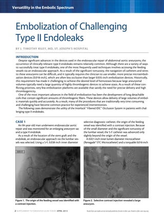 2 Supplement to Endovascular Today April 2013
Versatility in the Embolic Spectrum
By J. Timothy Riley, MD, St. Joseph’s Hospital
Embolization of Challenging
Type II Endoleaks
CASE 1
An 84-year-old man underwent endovascular aortic
repair and was monitored for an enlarging aneurysm sac
and a type II endoleak.
As a result of the location of the stent graft and the
endoleak, an endovascular approach via the lumbar ves-
sels was selected. Using a 5-F, 0.038-inch inner diameter
selective diagnostic catheter, the origin of the feeding
vessel was identified with a contrast injection. Because
of the small diameter and the significant tortuosity of
the lumbar vessel, the 5-F catheter was advanced only
slightly beyond the origin of the vessel.
A 0.021-inch inner lumen diameter microcatheter
(Renegade® STC Microcatheter) and a torquable 0.016-inch
INTRODUCTION
Despite significant advances in the devices used in the endovascular repair of abdominal aortic aneurysms, the
occurrence of clinically relevant type II endoleaks remains relatively common. Although there are a variety of ways
to successfully treat type II endoleaks, one of the most frequently used techniques involves accessing the feeding
vessels via an endovascular approach. As a result of the significant tortuosity, the navigation of catheters and wires
to these aneurysms can be difficult, and it typically requires the clinician to use smaller, more precise microemboli-
zation devices (0.018-inch), which are often less occlusive than larger 0.035-inch embolization devices. Historically,
this requirement has made it challenging to achieve the desired level of hemostasis because large aneurysmal
volumes typically need a large quantity of highly thrombogenic devices to achieve stasis. As a result of these con-
flicting priorities, very few embolization platforms are available that satisfy the need for precise delivery and high
thrombogenicity.
One of the most important advances in the field of embolization has been the development of long detachable
coils that contain significant amounts of thrombogenic fibers. These devices allow delivery of large volumes of embol-
ic materials quickly and accurately. As a result, many of the procedures that are traditionally very time consuming
and challenging have become common practice for experienced interventionists.
The following cases demonstrate the utility of the Interlock™ Fibered IDC™ Occlusion System in patients with chal-
lenging type II endoleaks.
Figure 1. The origin of the feeding vessel was identified with
a contrast injection.
Figure 2. Selective contrast injection revealed a large
aneurysm.
Results from case studies are not necessarily predictive of results in other cases. Results in other cases may vary.
 