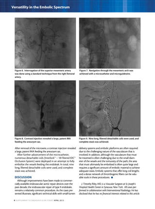 4 Supplement to Endovascular Today April 2013
Versatility in the Embolic Spectrum
After removal of the microwire, a contrast injection revealed
a large, patent IMA feeding the aneurysm sac.
After further advancement of the microcatheter,
numerous detachable coils (Interlock™ – 18 Fibered IDC™
Occlusion System) were deployed in an attempt to fully
embolize the vessels feeding the endoleak. In total, nine
long, fibered detachable coils were used, and complete
stasis was achieved.
DISCUSSION
Although improvements have been made to commer-
cially available endovascular aortic repair devices over the
past decade, the endovascular repair of type II endoleaks
remains a relatively common procedure. As the cases pre-
sented illustrate, significant technical skills with small-lumen
delivery systems and embolic platforms are often required
due to the challenging nature of the vasculature that is
involved. In addition, although the vasculature that must
be traversed is often challenging due to the small diam-
eter of the vessels and the tortuosity of the path, the area
that must ultimately be embolized is often quite large and
requires a significant amount of embolic material to achieve
adequate stasis. Embolic systems that offer long coil lengths
and a dense network of thrombogenic fibers can be valu-
able tools in these procedures.  n
J. Timothy Riley, MD, is a Vascular Surgeon at St. Joseph’s
Hospital Health Center in Syracuse, New York. All cases per-
formed in collaboration with Interventional Radiology. He has
disclosed that he has no financial interests related to this article.
Figure 6. Interrogation of the superior mesenteric artery
was done using a standard technique from the right femoral
artery.
Figure 7. Navigation through the mesenteric arch was
achieved with a microcatheter and microguidewire.
Figure 9. Nine long, fibered detachable coils were used, and
complete stasis was achieved.
Figure 8. Contrast injection revealed a large, patent IMA
feeding the aneurysm sac.
 