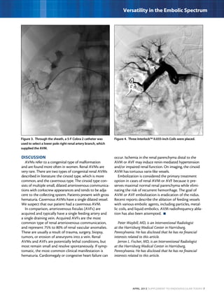 April 2013 Supplement to Endovascular Today 7
Versatility in the Embolic Spectrum
DISCUSSION
AVMs refer to a congenital type of malformation
and are found more often in women. Renal AVMs are
very rare. There are two types of congenital renal AVMs
described in literature: the cirsoid type, which is more
common, and the cavernous type. The cirsoid type con-
sists of multiple small, dilated arteriovenous communica-
tions with corkscrew appearances and tends to be adja-
cent to the collecting system. Patients present with gross
hematuria. Cavernous AVMs have a single dilated vessel.
We suspect that our patient had a cavernous AVM.
In comparison, arteriovenous fistulas (AVFs) are
acquired and typically have a single feeding artery and
a single draining vein. Acquired AVFs are the most
common type of renal arteriovenous communication,
and represent 75% to 80% of renal vascular anomalies.
These are usually a result of trauma, surgery, biopsy,
tumors, or erosion of aneurysms into a vein. Renal
AVMs and AVFs are potentially lethal conditions, but
most remain small and resolve spontaneously. If symp-
tomatic, the most common clinical manifestation is
hematuria. Cardiomegaly or congestive heart failure can
occur. Ischemia in the renal parenchyma distal to the
AVM or AVF may induce renin-mediated hypertension
and/or impaired renal function. On imaging, the cirsoid
AVM has tortuous varix-like vessels.
Embolization is considered the primary treatment
option in cases of renal AVM or AVF because it pre-
serves maximal normal renal parenchyma while elimi-
nating the risk of recurrent hemorrhage. The goal of
AVM or AVF embolization is eradication of the nidus.
Recent reports describe the ablation of feeding vessels
with various embolic agents, including particles, metal-
lic coils, and liquid embolics. AVM radiofrequency abla-
tion has also been attempted.  n
Peter Waybill, MD, is an Interventional Radiologist
at the Harrisburg Medical Center in Harrisburg,
Pennsylvania. He has disclosed that he has no financial
interests related to this article.
Jerron L. Fischer, MD, is an Interventional Radiologist
at the Harrisburg Medical Center in Harrisburg,
Pennsylvania. He has disclosed that he has no financial
interests related to this article.
Figure 3. Through the sheath, a 5-F Cobra 2 catheter was
used to select a lower pole right renal artery branch, which
supplied the AVM.
Figure 4. Three Interlock™ 0.035-inch Coils were placed.
 