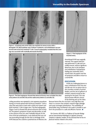 April 2013 Supplement to Endovascular Today 9
Versatility in the Embolic Spectrum
coiling procedure was repeated in nine separate procedures
during a 6-month period with 0.018-inch Interlock™ Coils in
veins that were hard to reach with a 0.035-inch system and
0.035 Interlock™ Coils in larger veins. The final angiography
(Figure 3 and 4) showed that almost all shunts were occlud-
ed. The patient’s symptoms of pain and discomfort, as well
as the volume of the arm, were markedly reduced. At the
time of the last embolization, it was observed that one coil
was protruding through the skin due to shrinkage of the
AVM. Because this could be a potential site of infection, the
thrombosed AVM was surgically
resected. The surgical resection
was performed in a safe and con-
trolled manner, without significant
blood loss, due to the preopera-
tive embolization. Postoperative
healing was uneventful, and 6
months later, the patient was free
of symptoms and able to return to
a normal life.
DISCUSSION
AVMs are challenging lesions to
treat. Embolization from the arte-
rial side was not an option due to
the countless number of arterial
feeders, and the risk of spillover of
embolic material would be dev-
astating for the hand. This case
demonstrates efficient closure
of the draining vein at the nidus.
Because lesions like this one have a very high flow rate,
there is a concern that embolic material might dislodge
and cause nontarget embolization. The availability of
detachable, long, and fibered coils made it possible to per-
form the procedure in a safe and efficient manner.  n
Pär Gerwins, MD, PhD, is a Professor of Vascular Biology
and an Interventional Radiologist at Uppsala University
Hospital in Uppsala, Sweden. He has disclosed that he has no
financial interests related to this article.
Figure 2. A draining vein at the nidus was reached via venous access with a
Renegade® STC Microcatheter and a Fathom® Guidewire, and embolization was per-
formed with 0.018-inch Interlock™ Coils. Control angiography revealed that this strat-
egy was successful with markedly decreased shunting.
Figure 4. The final angiogram showed that almost all shunts were occluded: the ulnar
artery before (A) and after (B) and the radial artery before (C) and after (D).
Figure 3. Final angiogram of the
brachial artery.
BA C D
 