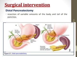 Surgical intervention
Distal Pancreatectomy
• resection of variable amounts of the body and tail of the
pancreas.
10/4/2023
Neelima
Shakya
34
 