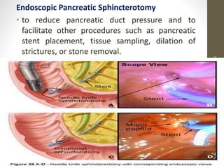 Endoscopic Pancreatic Sphincterotomy
• to reduce pancreatic duct pressure and to
facilitate other procedures such as pancreatic
stent placement, tissue sampling, dilation of
strictures, or stone removal.
10/4/2023
Neelima
Shakya
35
 