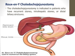 Roux-en-Y Choledochojejunostomy
• The choledochojejunostomy is indicated in patients who
have recurrent stones, intrahepatic stones, or distal
biliary strictures.
10/4/2023
Neelima
Shakya
36
 