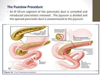 The Puestow Procedure
• An 8–10-cm segment of the pancreatic duct is unroofed and
intraductal concretions removed . The jejunum is divided and
the opened pancreatic duct is anastomosed to the jejunum.
10/4/2023
Neelima
Shakya
37
 