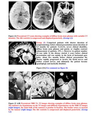 Figure [1] Precontrast CT scans showing examples of diffuse brain stem gliomas with variable CT
densities. The 4th ventricle is compressed and displaced posteriorly. (Group 1,2)

                                  Group (2) Comprised patients with shorter duration of
                                  symptomatology before clinical presentation (mean duration of
                                  4.3 months for patients 11,12,13), severe clinical disability,
                                  diffuse brain stem gliomas and patchy or ringlike contrast
                                  enhancement (4 patients, 19% ). However in patient number
                                  14 (see table 2) the disease started 4 years before clinical
                                  presentation and was mainly in the form of horizontal gaze
                                  palsy, about five months before clinical presentation the
                                  disease rapidly progressed to involve the facial nerves and
                                  bulbar cranial nerves, and ultimately the patient became
                                  quadriplegic and markedly disabled.

                                  Figure [2A] For comment see figure 2b




Figure [2 A,B] Precontrast MRI T1, T2 images showing examples of diffuse brain stem gliomas.
The tumours are hypointense on the T1 images and diffusely hyperintense on the MRI T2 images
(right images), the main bulk of the tumours is pontine in location. The basilar artery is encased
by the tumour (right image) The 4th ventricle is compressed and displaced posteriorly. (Group
1,2)
 
