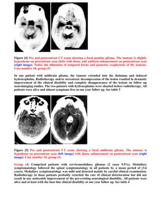 Figure [4] Pre and postcontrast CT scans showing a focal pontine glioma. The tumour is slightly
hyperdense on precontrast scan (left) with dense and uniform enhancement on postcontrast scan
(right image). Notice the dilatation of temporal horns and posterior exophytosis of the tumour.
Case number 18, group (3)

In one patient with midbrain glioma, the tumour extended into the thalamus and induced
hydrocephalus. Radiotherapy and/or stereotaxic decompression of the lesion resulted in dramatic
improvement of the clinical disability and complete disappearance of the lesions on follow up
neuroimaging studies. The two patients with hydrocephalus were shunted before radiotherapy. All
patients were alive and almost symptoms free at one year follow up. See table 3




Figure [5] Pre and postcontrast CT scans showing a focal midbrain glioma. The tumour is
hypodense on precontrast scan (left image) with dense enhancement on postcontrast scan (right
image). Case number 16, group (3)

Group (4) Comprised patients with cervicomedullary gliomas (2 cases 9.5%). Medullary
symptomatology followed the spinal symptomatology in all patients by a mean period of (3.6
years). Medullary symptomatology was mild and detected mainly by careful clinical examination.
Radiotherapy in those patients probably retarded the rate of clinical deterioration but did not
result in any noticeable improvement of the pre-existing neurological disability. All patients were
alive and at least with the base line clinical disability at one year follow up. See table 4
 