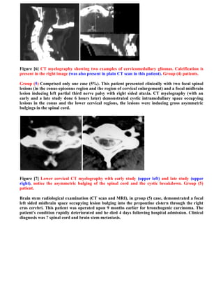 Figure [6] CT myelography showing two examples of cervicomedullary gliomas. Calcification is
present in the right image (was also present in plain CT scan in this patient). Group (4) patients.

Group (5) Comprised only one case (5%). This patient presented clinically with two focal spinal
lesions (in the conus-epiconus region and the region of cervical enlargement) and a focal midbrain
lesion inducing left partial third nerve palsy with right sided ataxia. CT myelography (with an
early and a late study done 6 hours later) demonstrated cystic intramedullary space occupying
lesions in the conus and the lower cervical regions, the lesions were inducing gross asymmetric
bulgings in the spinal cord.




Figure [7] Lower cervical CT myelography with early study (upper left) and late study (upper
right), notice the asymmetric bulging of the spinal cord and the cystic breakdown. Group (5)
patient.

Brain stem radiological examination (CT scan and MRI), in group (5) case, demonstrated a focal
left sided midbrain space occupying lesion bulging into the prepontine cistern through the right
crus cerebri. This patient was operated upon 9 months earlier for bronchogenic carcinoma. The
patient's condition rapidly deteriorated and he died 4 days following hospital admission. Clinical
diagnosis was ? spinal cord and brain stem metastasis.
 