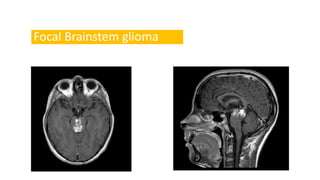 Focal Brainstem glioma
 