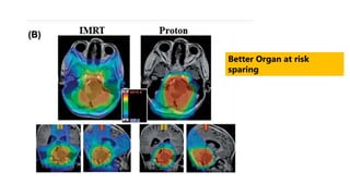 Better Organ at risk
sparing
 