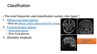 Classification
• The most frequently used classification system -four types 5:
1. Diffuse brainstem glioma
• Most are diffuse midline glioma H3 k27m–mutant
2. Focal brainstem glioma
• Tectal plate glioma
• Other focal gliomas
3. (Dorsally) exophytic
Tectal plate
glioma
 