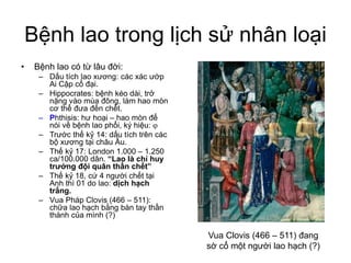 Bệnh lao trong lịch sử nhân loại
• Bệnh lao có từ lâu đời:
– Dấu tích lao xương: các xác ướp
Ai Cập cổ đại.
– Hippocrates: bệnh kéo dài, trở
nặng vào mùa đông, làm hao mòn
cơ thể đưa đến chết.
– Phthisis: hư hoại – hao mòn để
nói về bệnh lao phổi, ký hiệu: 
– Trước thế kỷ 14: dấu tích trên các
bộ xương tại châu Âu.
– Thế kỷ 17: London 1.000 – 1.250
ca/100.000 dân. “Lao là chỉ huy
trưởng đội quân thần chết”
– Thế kỷ 18, cứ 4 người chết tại
Anh thì 01 do lao: dịch hạch
trắng.
– Vua Pháp Clovis (466 – 511):
chữa lao hạch bằng bàn tay thần
thánh của mình (?)
Vua Clovis (466 – 511) đang
sờ cổ một người lao hạch (?)
 