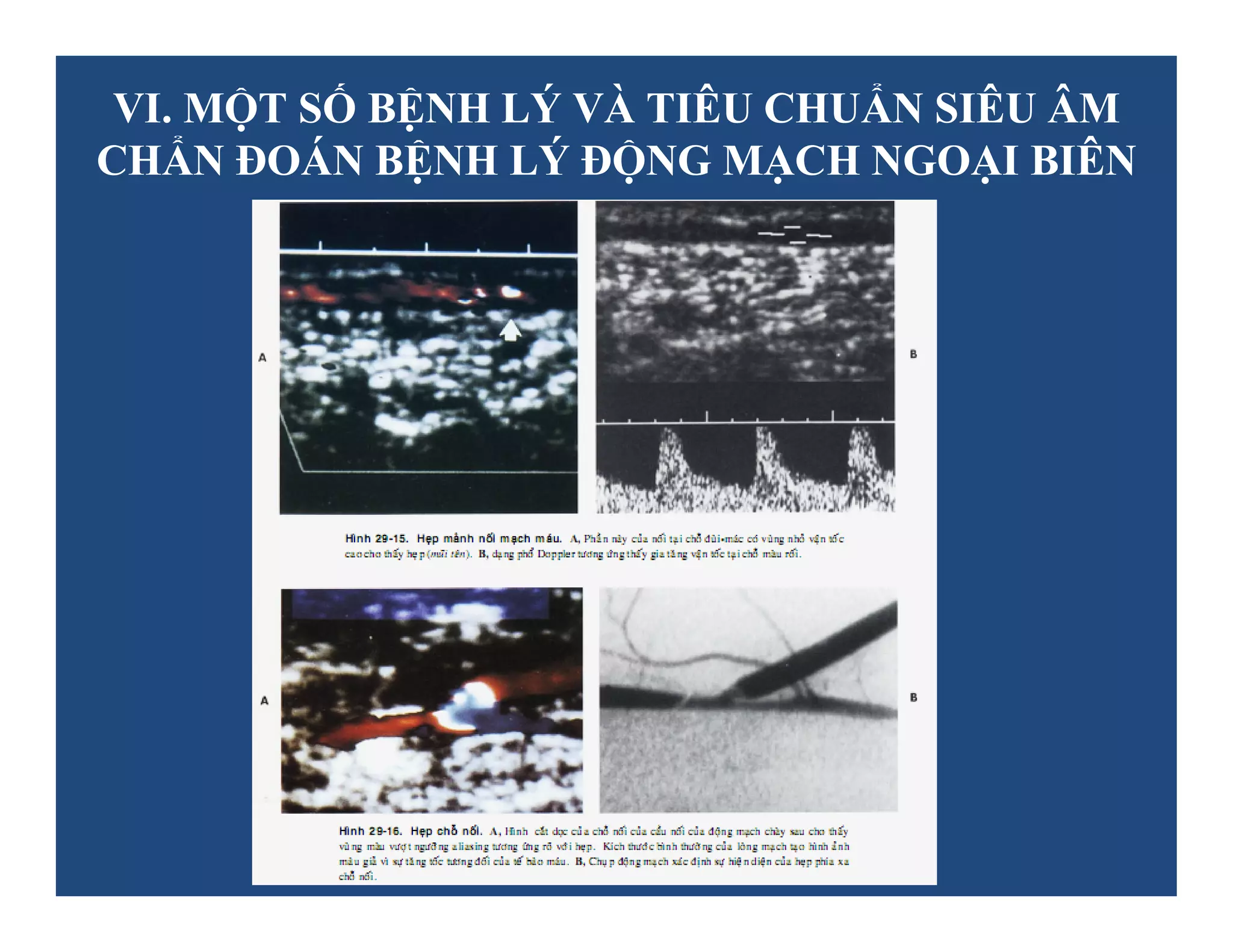 Siêu âm Doppler động mạch ngoại biên | PDF