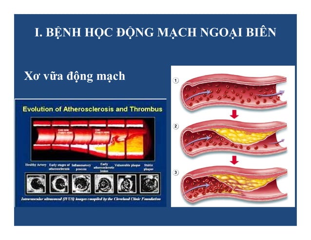 Siêu âm Doppler động mạch ngoại biên | PDF