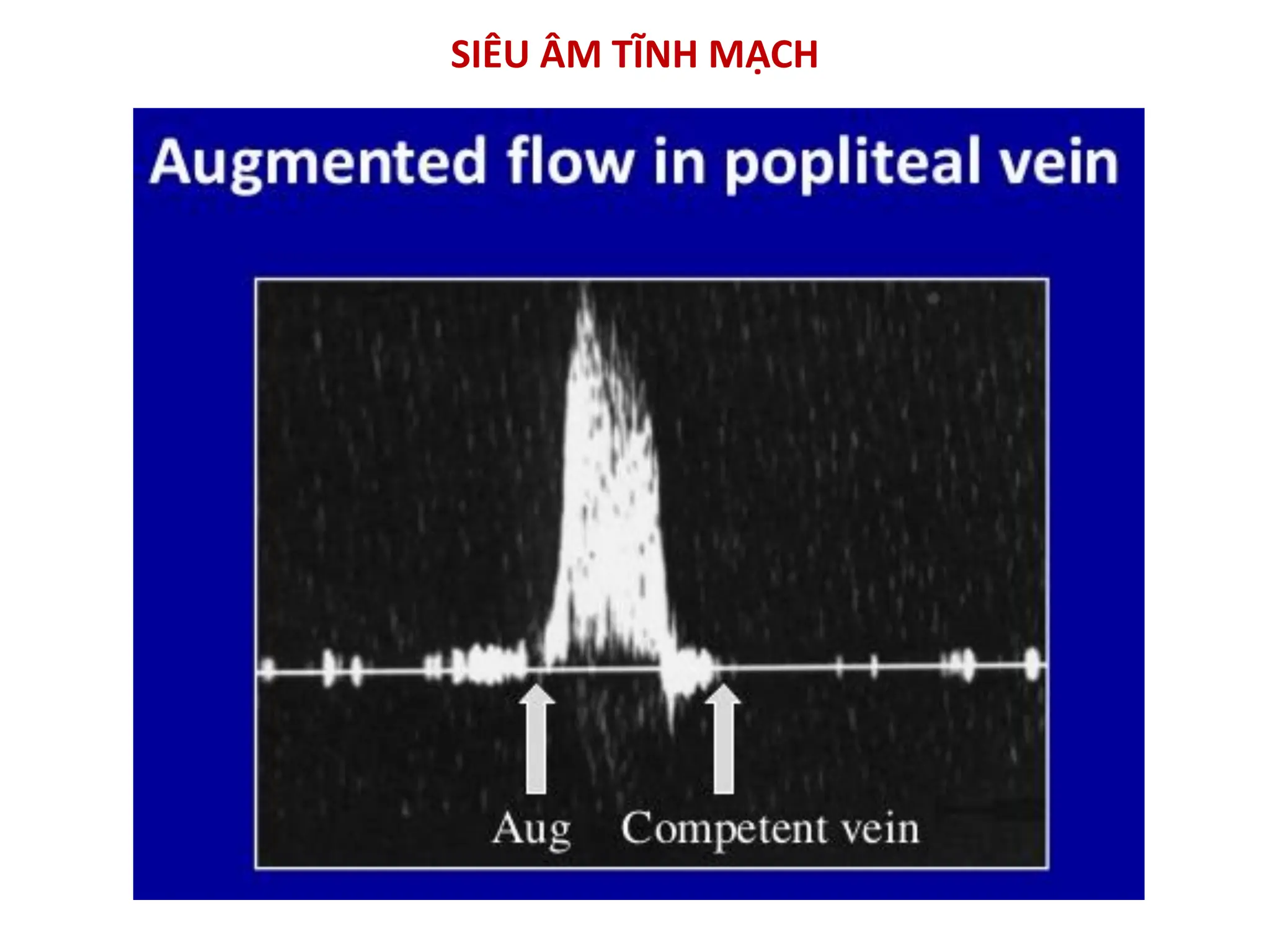 Bs Phuong - Nguyen ly co ban sieu am Doppler mach mau.pdf