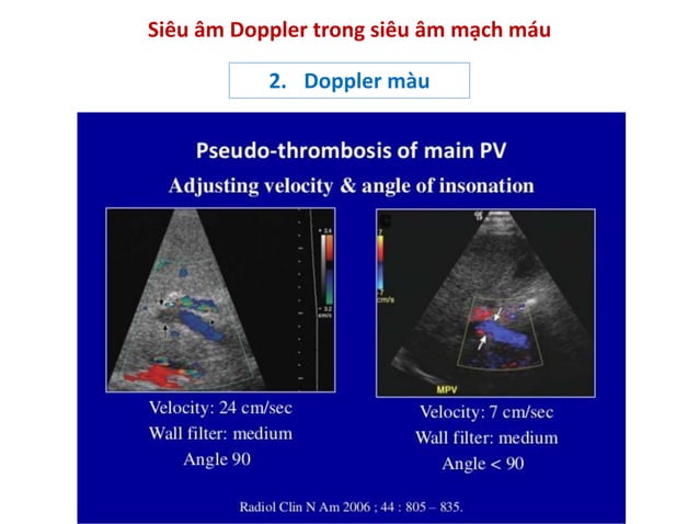 Bs Phuong - Nguyen ly co ban sieu am Doppler mach mau.pdf