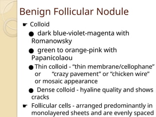 Benign Follicular Nodule
☛ Colloid
● dark blue-violet-magenta with
Romanowsky
● green to orange-pink with
Papanicolaou
● Thin colloid - “thin membrane/cellophane”
or “crazy pavement” or “chicken wire”
or mosaic appearance
● Dense colloid - hyaline quality and shows
cracks
☛ Follicular cells - arranged predominantly in
monolayered sheets and are evenly spaced
 