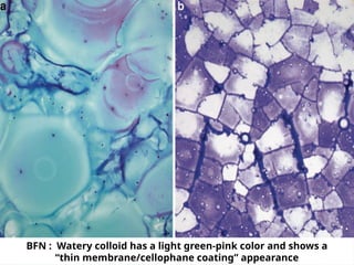 BFN : Watery colloid has a light green-pink color and shows a
“thin membrane/cellophane coating” appearance
 