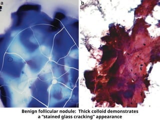 Benign follicular nodule: Thick colloid demonstrates
a “stained glass cracking” appearance
 