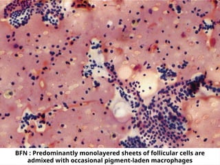 BFN : Predominantly monolayered sheets of follicular cells are
admixed with occasional pigment-laden macrophages
 