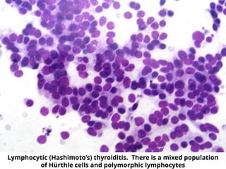 Lymphocytic (Hashimoto’s) thyroiditis. There is a mixed population
of Hürthle cells and polymorphic lymphocytes
 