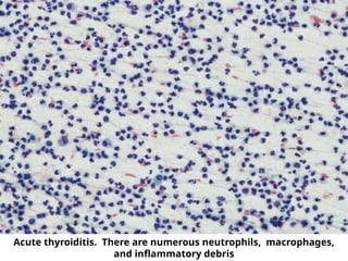 Acute thyroiditis. There are numerous neutrophils, macrophages,
and inflammatory debris
 