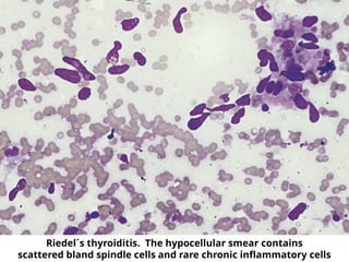 Riedel´s thyroiditis. The hypocellular smear contains
scattered bland spindle cells and rare chronic inflammatory cells
 