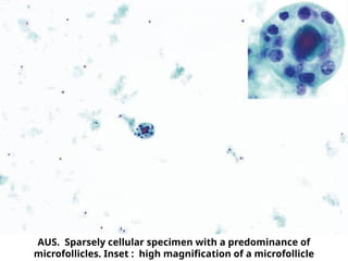 AUS. Sparsely cellular specimen with a predominance of
microfollicles. Inset : high magnification of a microfollicle
 