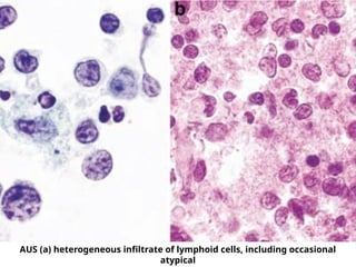 AUS (a) heterogeneous infiltrate of lymphoid cells, including occasional
atypical
 