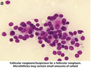 Follicular neoplasm/Suspicious for a follicular neoplasm.
Microfollicles may contain small amounts of colloid
 