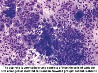 The aspirate is very cellular and consists of Hürthle cells of variable
size arranged as isolated cells and in crowded groups; colloid is absent
 