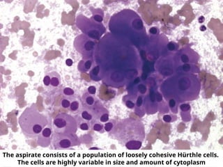 The aspirate consists of a population of loosely cohesive Hürthle cells.
The cells are highly variable in size and amount of cytoplasm
 