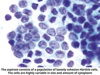 The aspirate consists of a population of loosely cohesive Hürthle cells.
The cells are highly variable in size and amount of cytoplasm
 