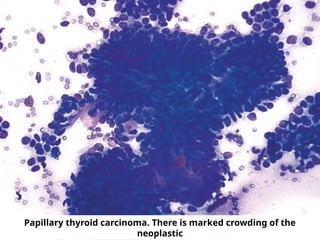 Papillary thyroid carcinoma. There is marked crowding of the
neoplastic
 