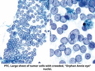 PTC. Large sheet of tumor cells with crowded, “Orphan Annie eye”
nuclei.
 