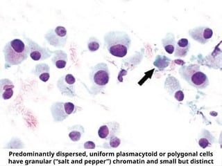 Predominantly dispersed, uniform plasmacytoid or polygonal cells
have granular (“salt and pepper”) chromatin and small but distinct
 